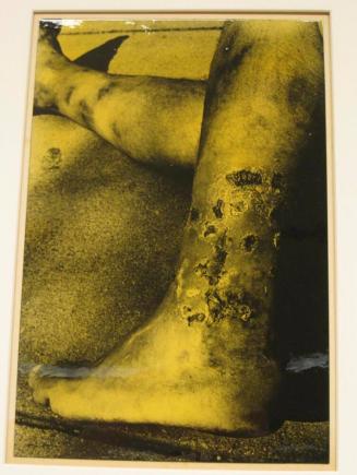 Untitled (sores on ankles, DC)