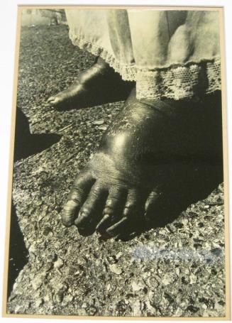 Untitled (woman in lace dress with swollen feet, DC)
