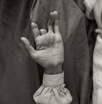 Mohammed Daud’s Hand, One Year after Picking up a Butterfly Mine He Thought Was a Toy, Afghan Refugee Village, Nasir Bagh, Northwest Frontier Province, Pakistan