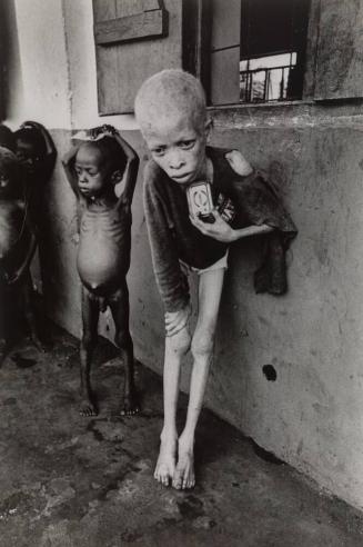 Albino boy, not only starving and at death's door, but ridiculed by fellow sufferers for skin pigmentation