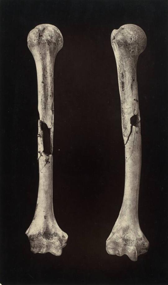 Shot Comminutions of the Humerus