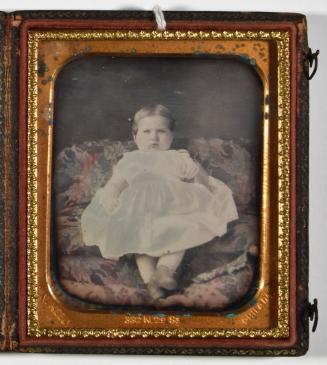 [Baby with Tinted Cheeks Seated on Floral Sofa with Head Clamp Visible]