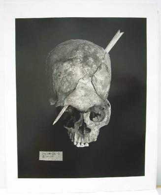 The Trajectory of a Bullet Through the Skull