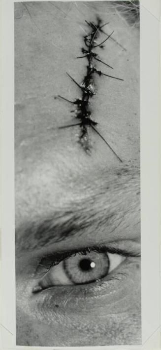 Eye and Stitches
